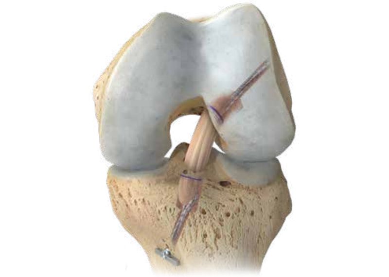 Rehabilitacije po rek. križne vezi