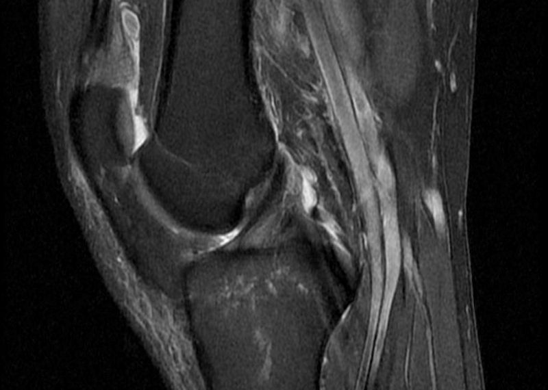 rekonstrukcija križne vezi, robi kelc