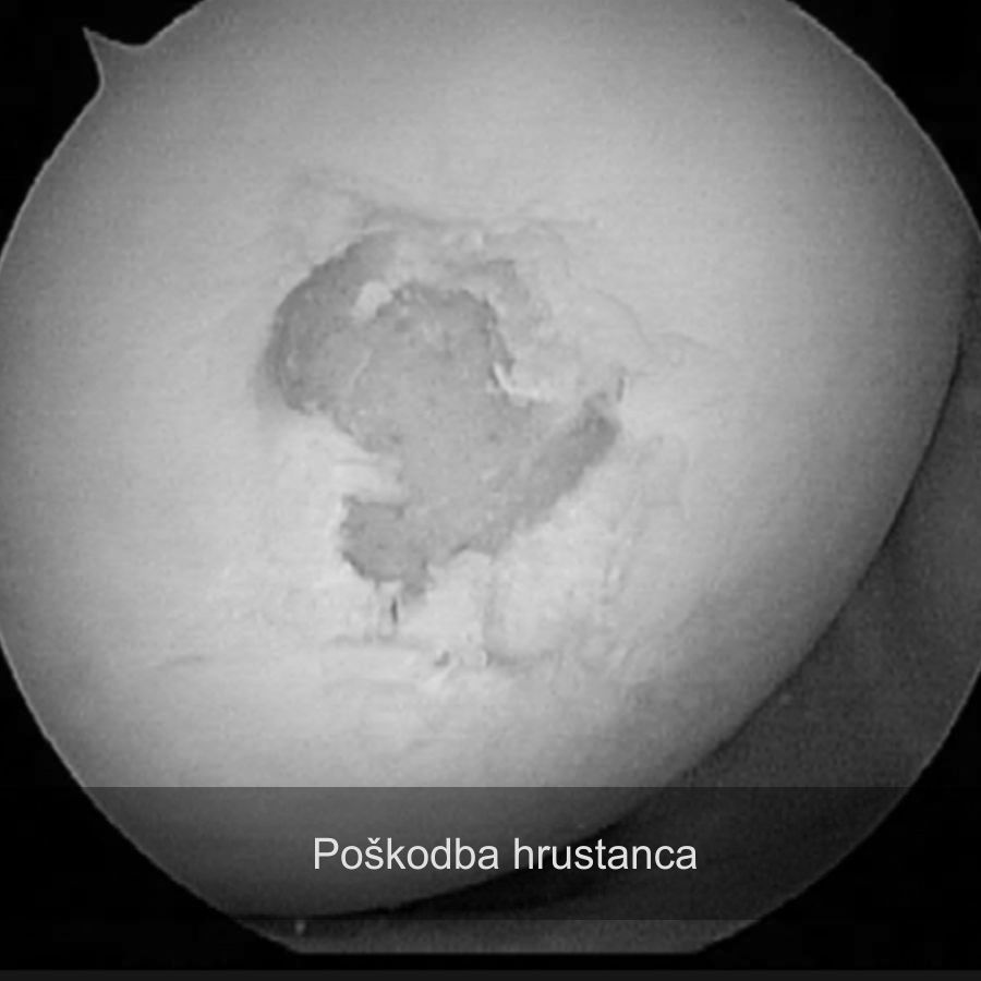 Poškodba hrustanca, dober ortoped za koleno, maribor