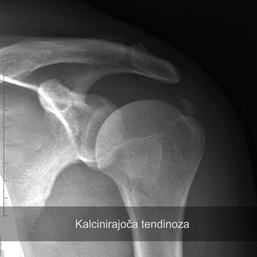 kalcinacije, rama, bolečina v rami