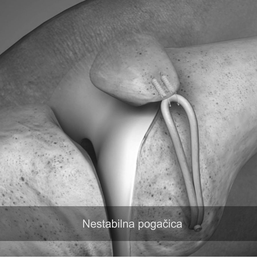 Nestabilnost pogačice, izpah pogačice, MPFL