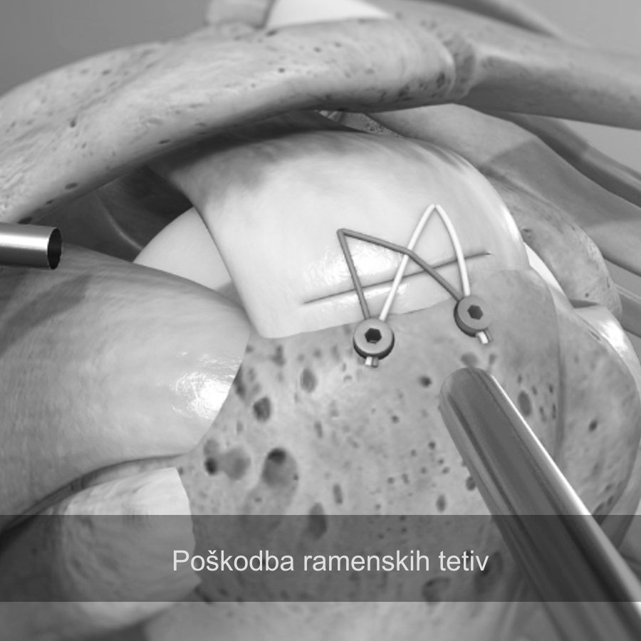 Ruptura rotatorne manšete, poškodba ramenskih tetiv, artroskopija rame, maribor