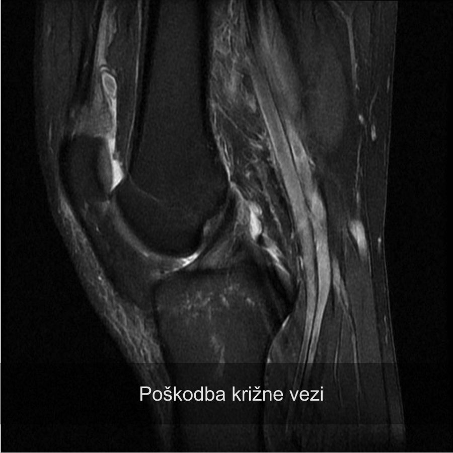 Poškodba sprednje križne vezi, operacija kolena, robi kelc