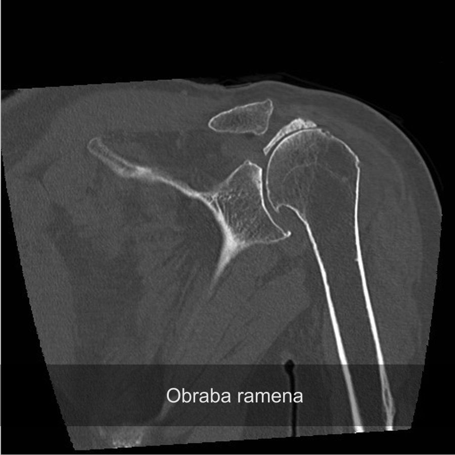 Najboljši ortoped za ramo, bolečine.