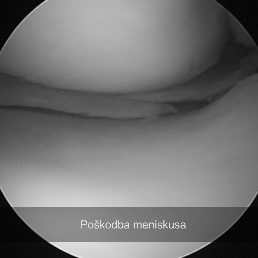 Poškodba meniskusa, artroskopija, najboljši ortoped za koleno maribor